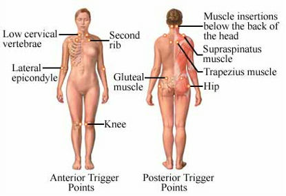 Chart of Fibromyalgia trigger point locations on the body.